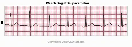 ARR 23_wandering_atrial_pacemaker